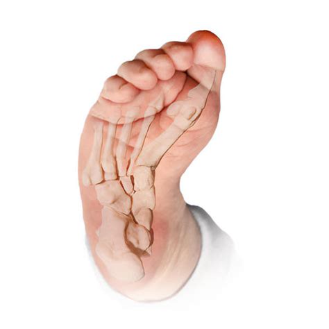 Metatarsus Adductus deformity | CLLC Montreal, Dr Marie Gdalevitch