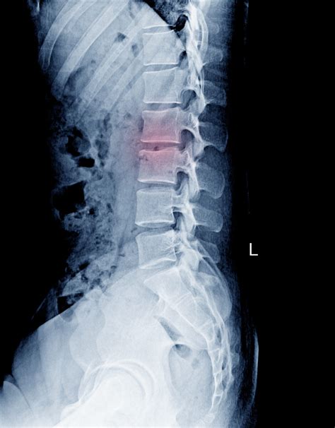 L-S Spine(Lumbo-SACRAL) AP. - Frisco Spine