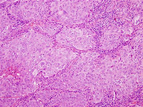 Non-Small Cell Lung Cancer - Cancer Therapy Advisor