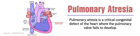 Pulmonary Atresia - Types, Symptoms, Diagnosis and Management