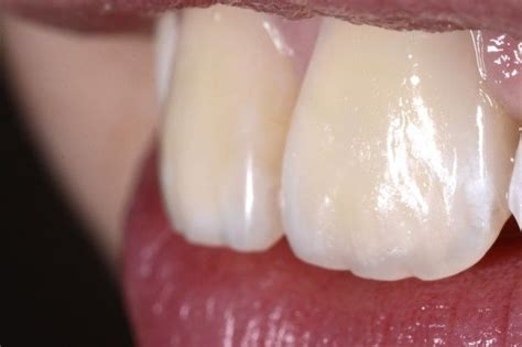 The Fountain of Youth: colour and incisal anatomy - Styleitaliano.org