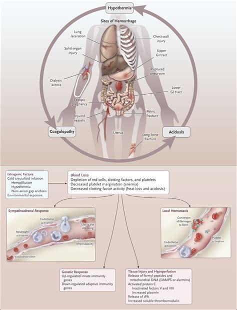 Hemorrhagic Shock | NEJM