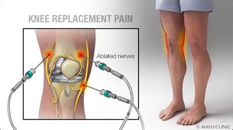 Mayo Clinic Q and A: Pain after knee replacement surgery - Mayo Clinic News Network