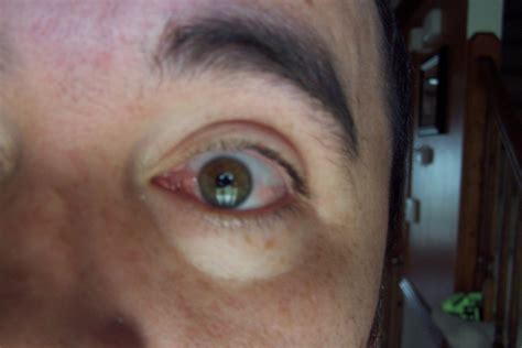 Pterygium Symptoms, Signs, Treatments, Recovery: Pre Pterygium Surgery Picture