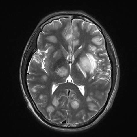 Cerebral toxoplasmosis | Radiology Case | Radiopaedia.org Airplane Coloring Pages, Mri Brain ...