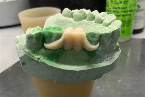 acetal resin unilateral partial - Robertson Dental Lab