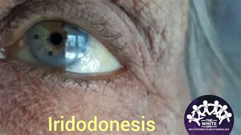 Iridodonesis