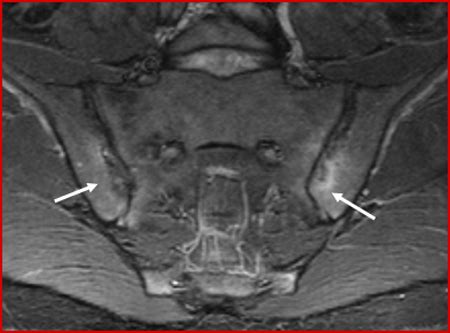 Mri Sacroiliitis