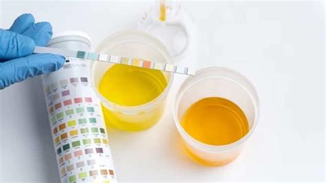 What urine colour tells about your kidneys, overall health | Health - Hindustan Times