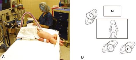 Laparoscopic Pyloromyotomy | Abdominal Key