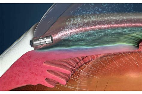 Positive Results for iDose TR Exchange Trial - mivision