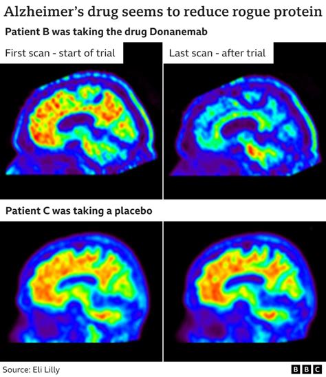 Drug donanemab seen as turning level in dementia battle – NanoApps ...