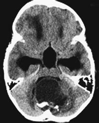 1 Cerebellar Juvenile Pilocytic Astrocytoma | Radiology Key