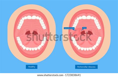 Tonsillar Cellulitis