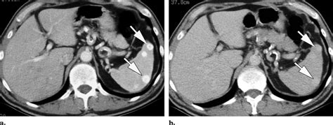 Multiple splenic hemangiomas in a 74-year-old asymptomatic man with a... | Download Scientific ...