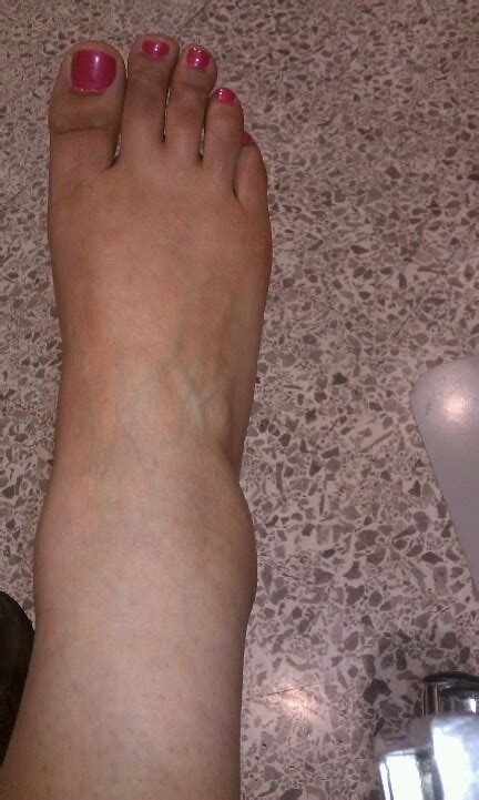 Broken Fibula, swollen ankle | ANKLE rehab | Pinterest