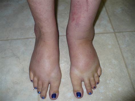 Lymphedema Treatment