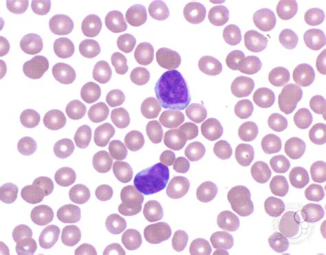 Peripheralizing Follicular Lymphoma with Atypical Morphology - 4.