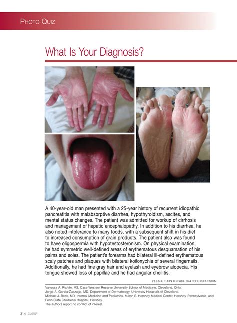 (PDF) What is your diagnosis? Acquired acrodermatitis enteropathica