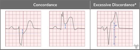 Sgarbossa Criteria | ECG Stampede