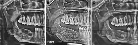 Central Giant Cell Granuloma Mandible