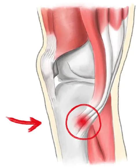 Pes Anserine Bursitis: Causes, Symptoms & Treatment