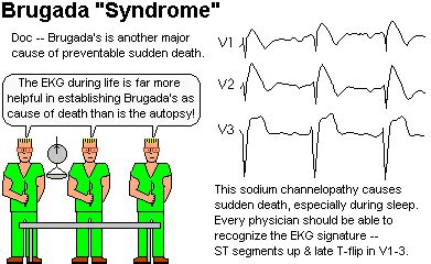 急診筆記: What is the Brugada syndrome?