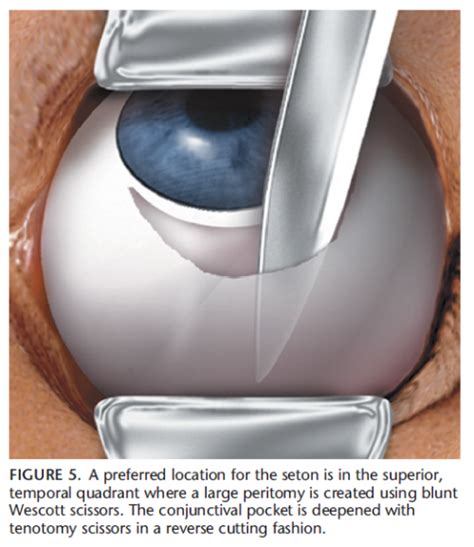 Trabeculectomy Example 1 - Laser Eye Surgery of Erie