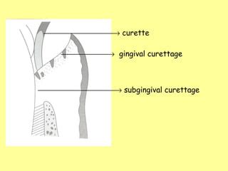 Gingival curettage | PPT