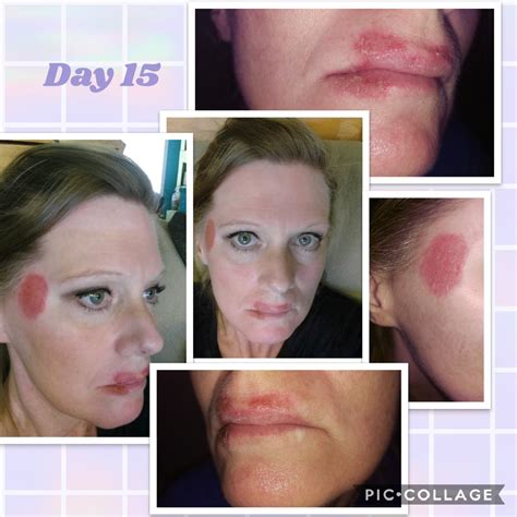 My Efudex Photo Journey: Topical Chemotherapy, 48% OFF