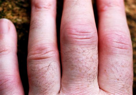 Rheumatoid Arthritis Fingers | An old photo, before my first… | Flickr