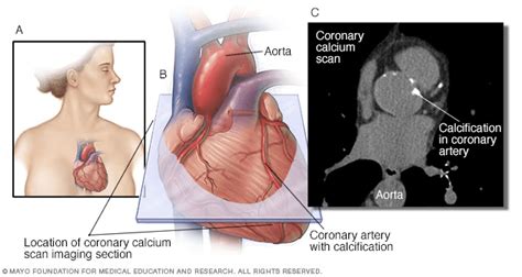 Calcium Score / CT Heart Scan