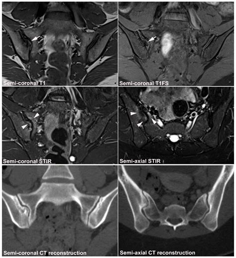 JCM | Free Full-Text | Diagnostics of Sacroiliac Joint Differentials to Axial Spondyloarthritis ...