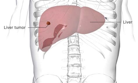 Liver tumor treated non-surgically by-RFA, TACE & TARE