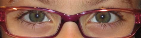 Accommodative Esotropia - Pediatric Ophthalmic Consultants