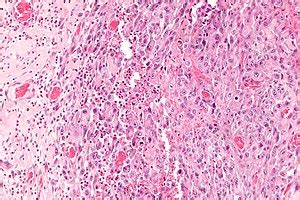 Epithelioid sarcoma - Libre Pathology