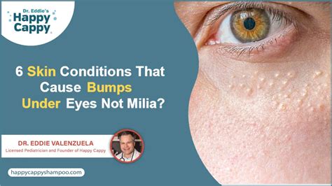 6 Skin Conditions That Cause Bumps Under Eyes Not Milia?