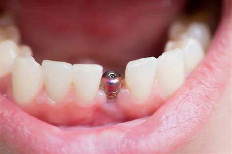 Are Titanium Dental Implants Dangerous? | Assure A Smile