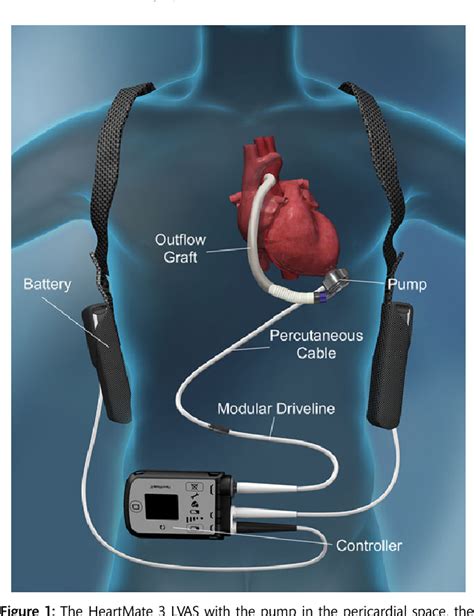 Figure 1 from Multicentre clinical trial experience with the HeartMate 3 left ventricular assist ...