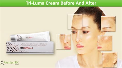 Tri-Luma Cream Before And After | PremiumRx- Online Pharmacy