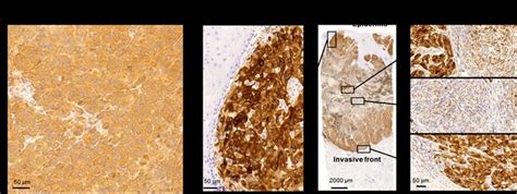 Expression of BRAF V600E mutation in melanoma tissue. With routine ...