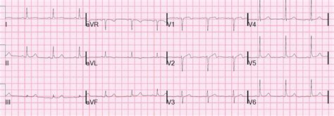 Dr. Smith's ECG Blog: Wellens' syndrome, no culprit, what happened?