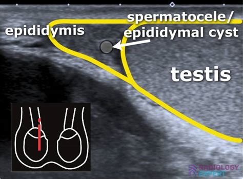 Scrotal ultrasound