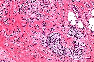 Invasive lobular carcinoma - Libre Pathology