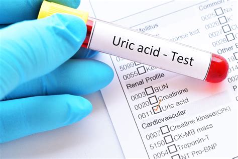 What Blood Test Shows Uric Acid Levels