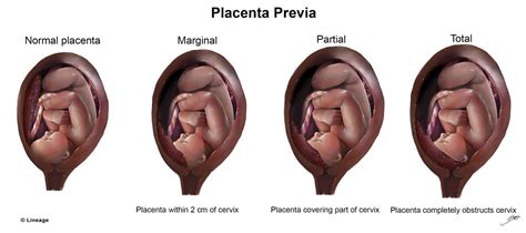 Placenta Previa - Reproductive - Medbullets Step 1