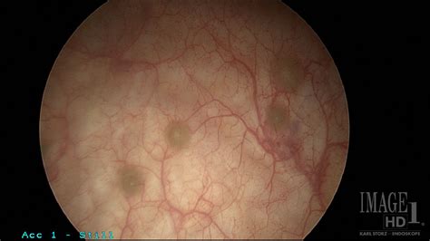 Cystitis Cystica on Routine Cystoscopy at Time of Total Laparoscopic ...