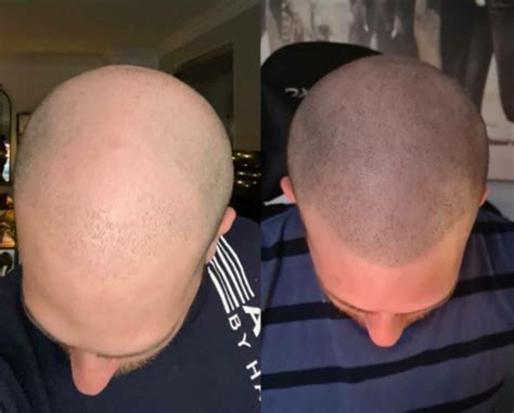 Scalp Micropigmentation Before and After - Totalprestige Magazine