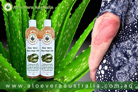 Does aloe vera work for psoriasis? - Aloe Vera Australia