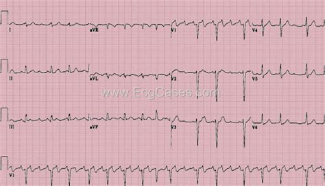 Stenosis: Ecg Mitral Stenosis